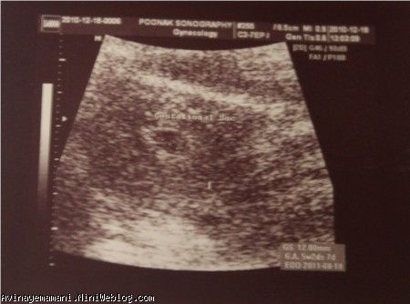 سونوگرافی 1 : هفته 5 . فقط ساک حاملگی تشکیل شده بود عزیزم