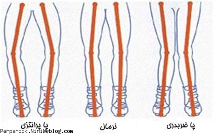 همهچیز درباره اختلالات اسکلتی کودکان همهچیز درباره اختلالات اسکلتی کودکان